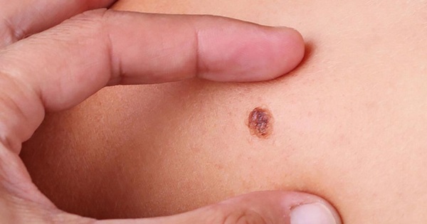 Giảm nguy cơ ung thư da