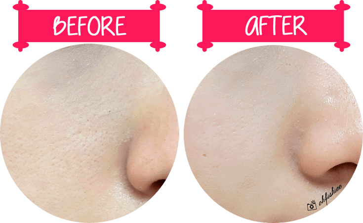 Vitamin C - Hoạt chất cứu tinh thâm mụn hiệu quả