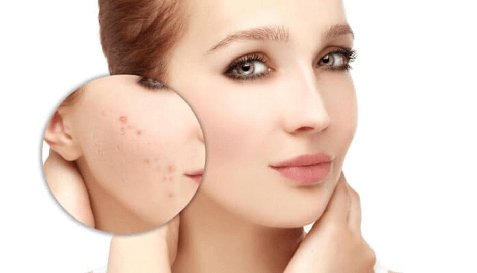 Vitamin C - Hoạt chất cứu tinh thâm mụn hiệu quả